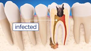 root_canal_infected